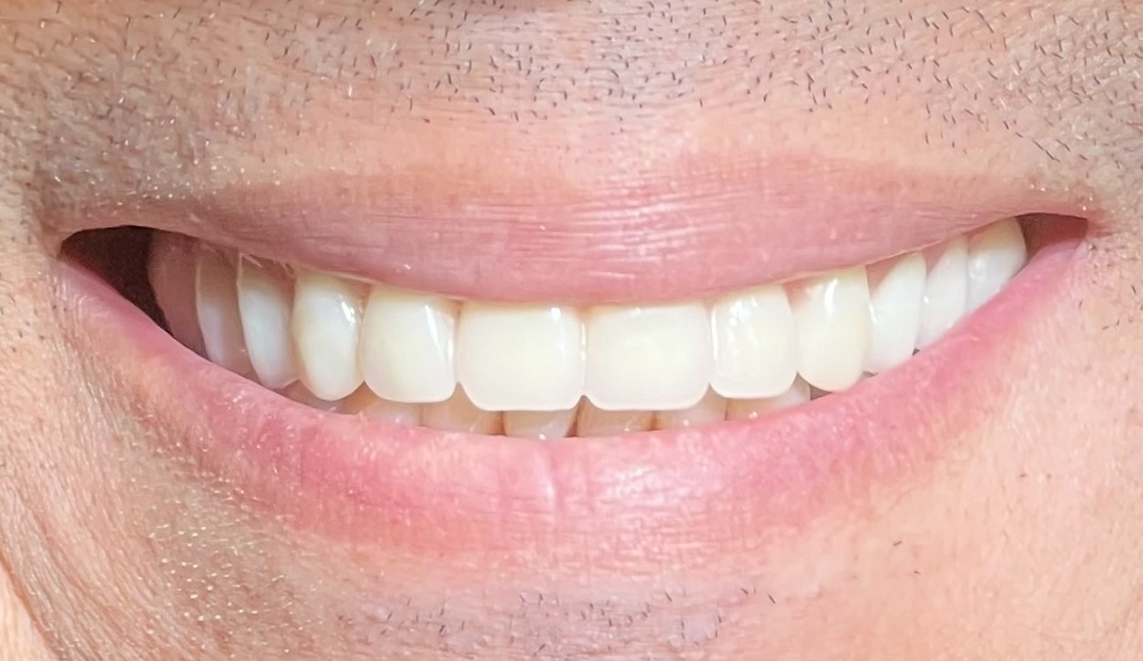 Complete Upper Dentures